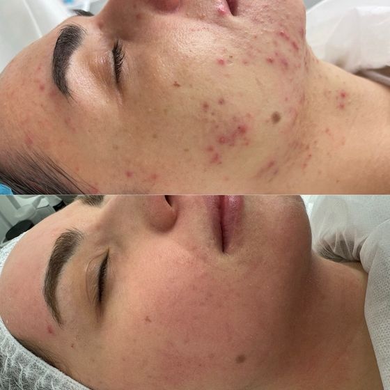 Acne Treatment Vancouver Photo Before After