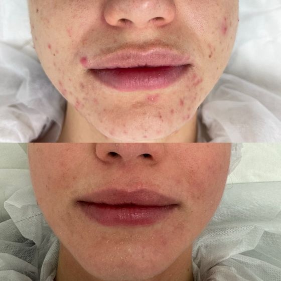 Acne Treatment Vancouver Photo Before After