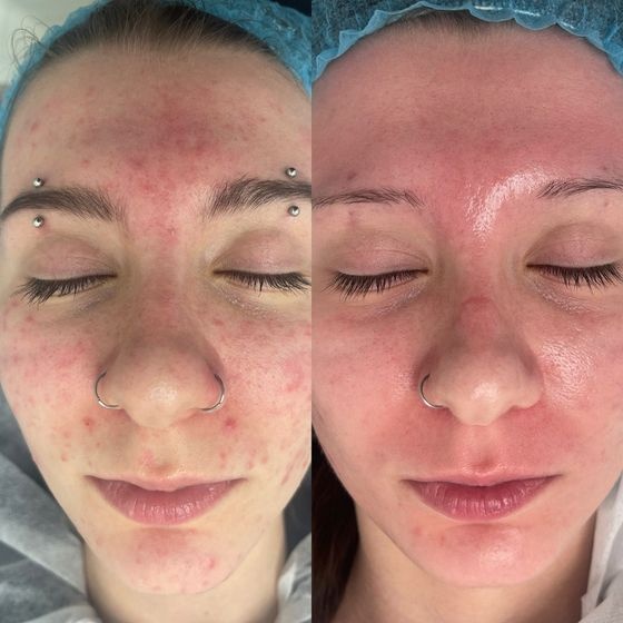 Acne Treatment Vancouver Photo Before After