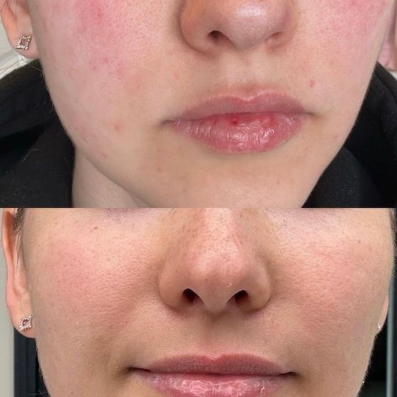 Acne Treatment Vancouver Photo Before After