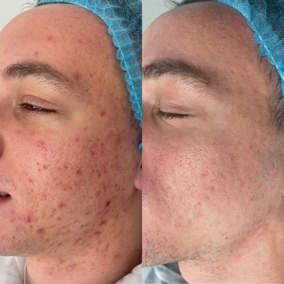 Acne Treatment Vancouver Photo Before After