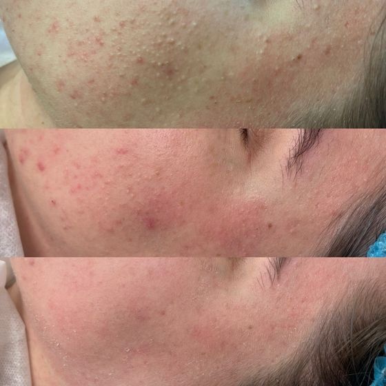 Acne Treatment Vancouver Photo Before After