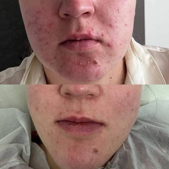 Acne Treatment Vancouver Photo Before After