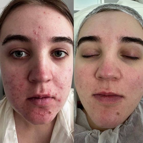 Acne Treatment Vancouver Photo Before After