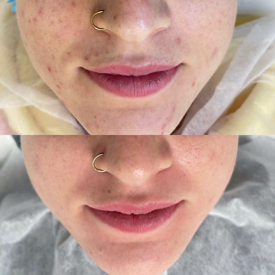 Acne Treatment Vancouver Photo Before After