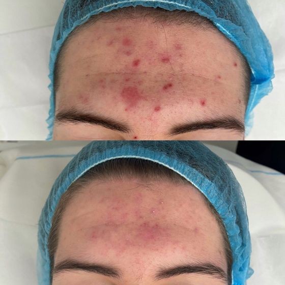 Acne Treatment Vancouver Photo Before After